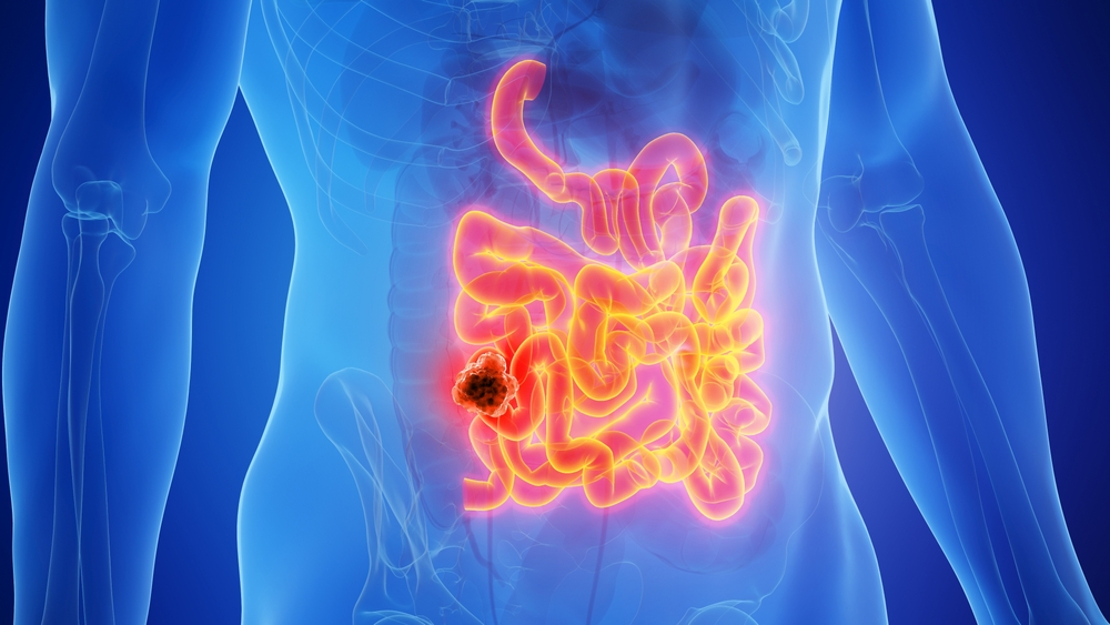 3d,Rendered,Medical,Illustration,Of,Male,Anatomy,-,Cancer,Of