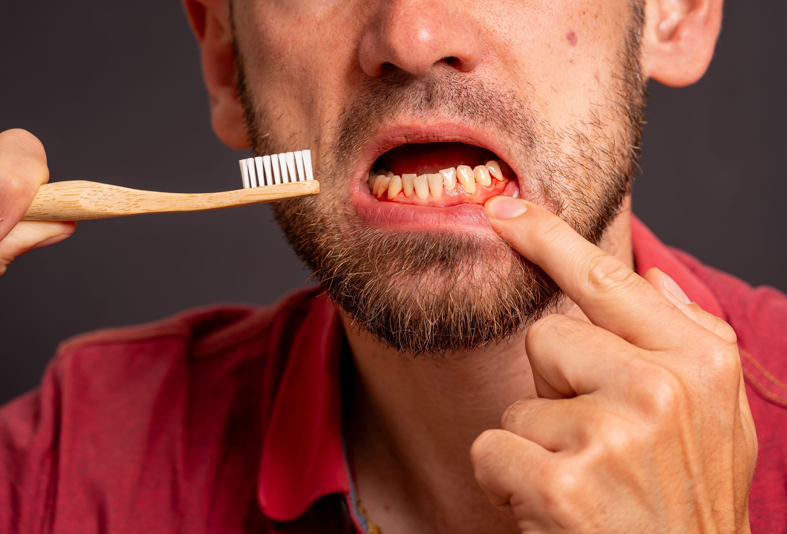 Man,Brushing,Teeth,Suffers,From,Inflamed,,Bleeding,Gums,As,A Image shows man with toothbrush and evidence of bleeding gums